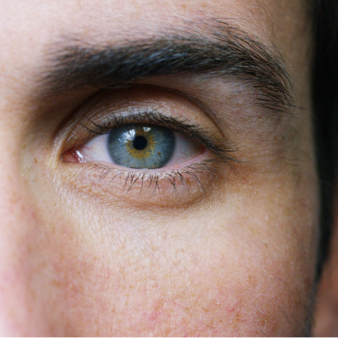 Glokom belirti vermeden kör edebilir!