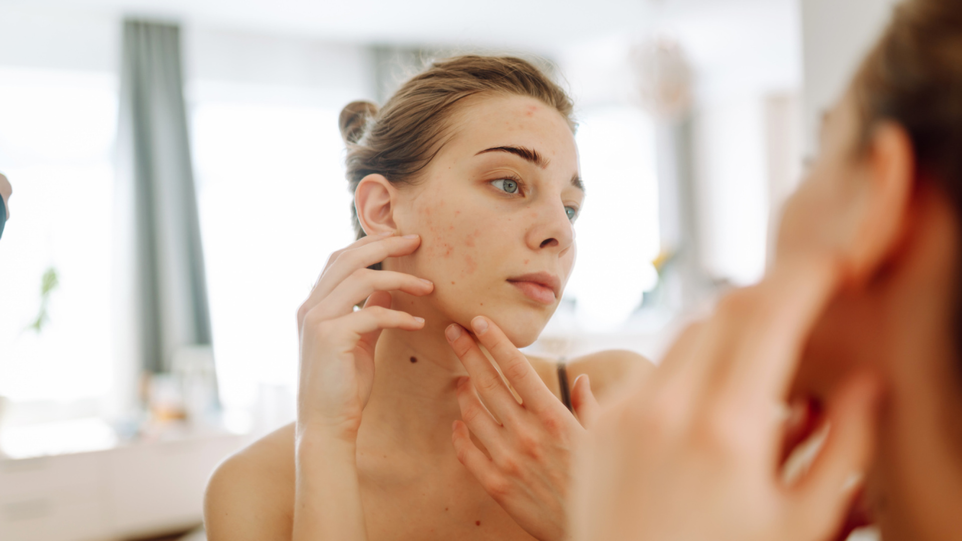 Sivilce sorununa iyi tarafından bakmak isteyenlere: Sivilce ve aknelerin olumlu bir özelliği ortaya çıktı!