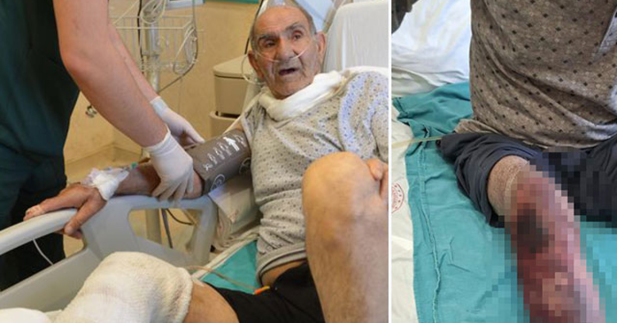 79 Yılındaki Babacanın Kimyasal Yanığı