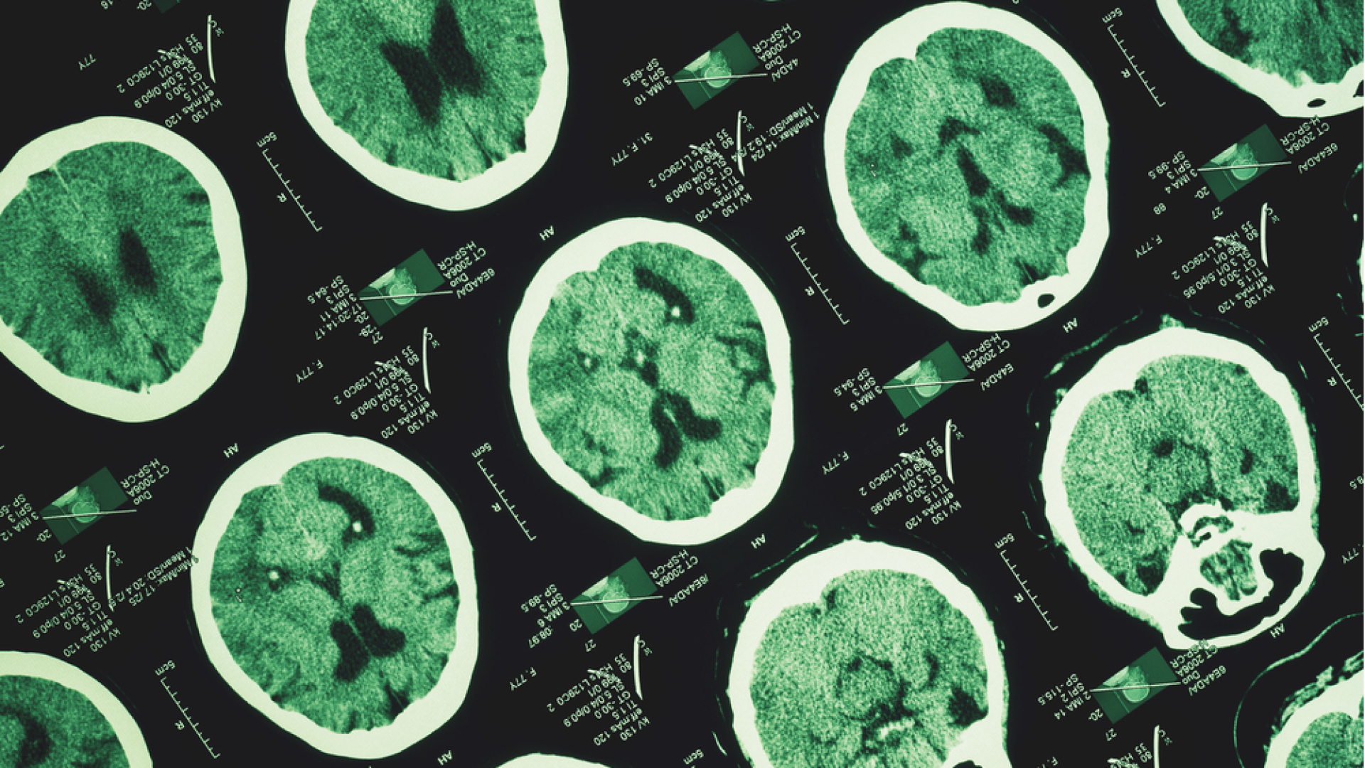 Türk Nöroloji Derneğinden Dünya Uyku Günü mesajı: Beynin sağlığı gece başlar | Sağlık Haberleri