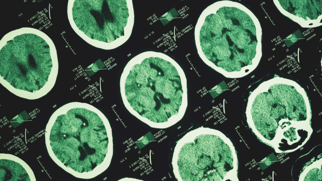 Türk Nöroloji Derneği: Beynin sağlığı gece başlar