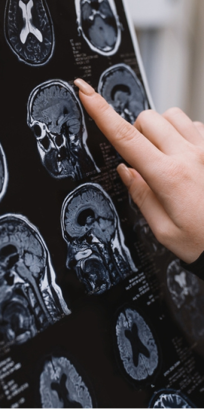 Alzheimer hastalarının üçte ikisi kadın!