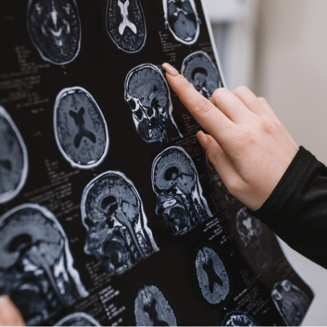 Alzheimer hastalarının üçte ikisi kadın!