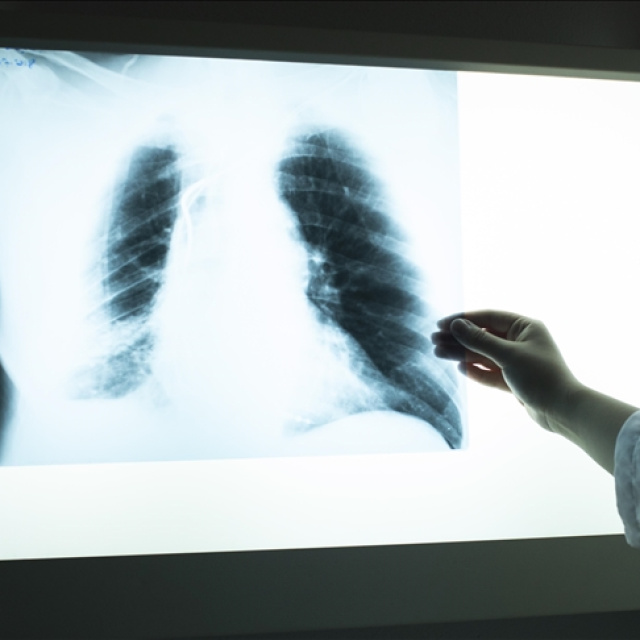 Tüberküloza her yıl 10 milyondan fazla kişi yakalanıyor