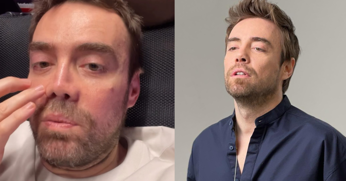 Murat Dalkılıç'in Burnu Hakkındaki Tüm Detayları