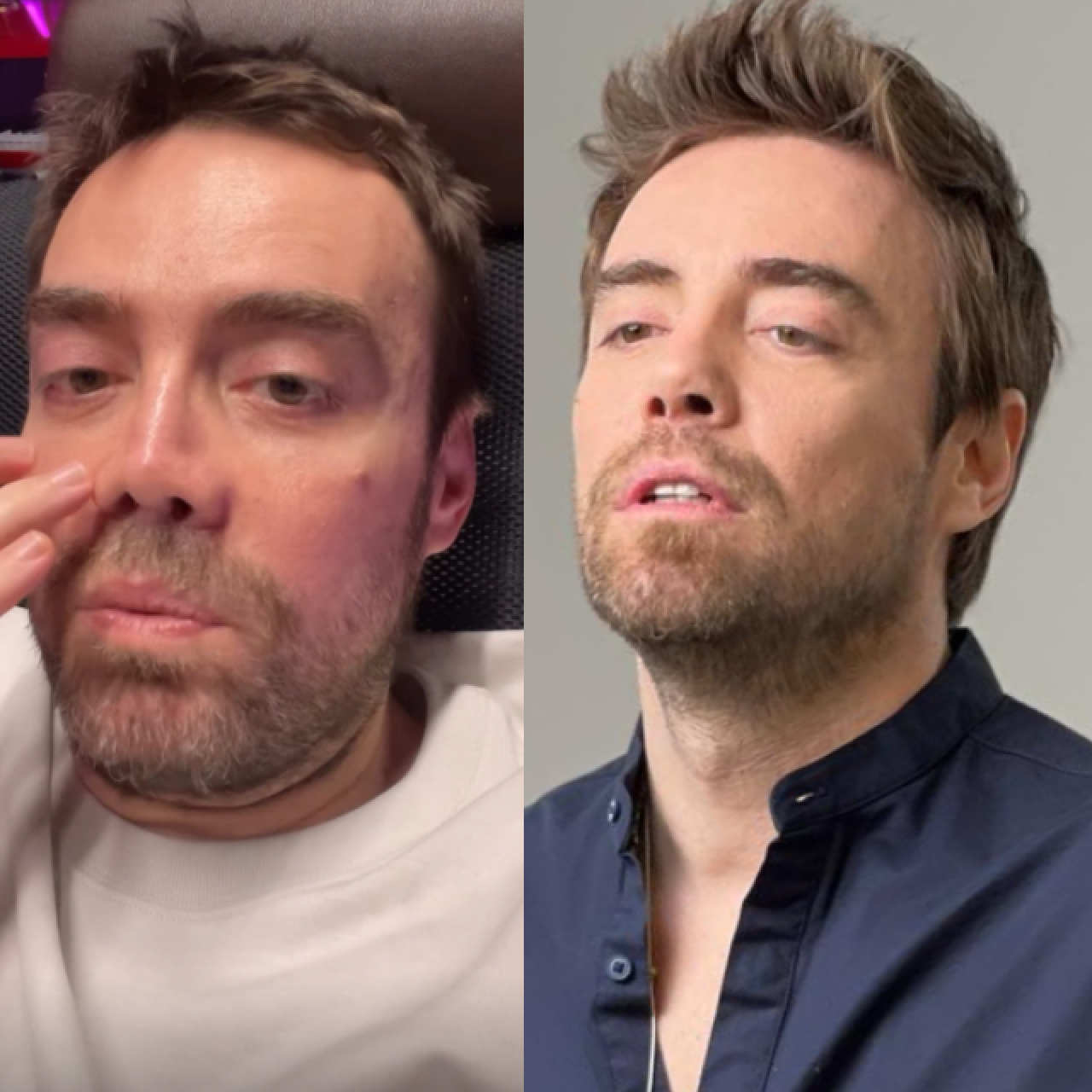 "İki sene sonra burnum oldu"