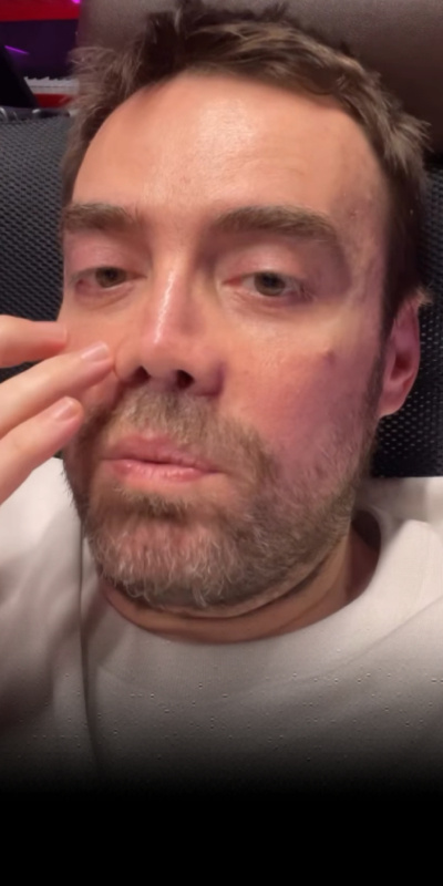 "İki sene sonra burnum oldu"