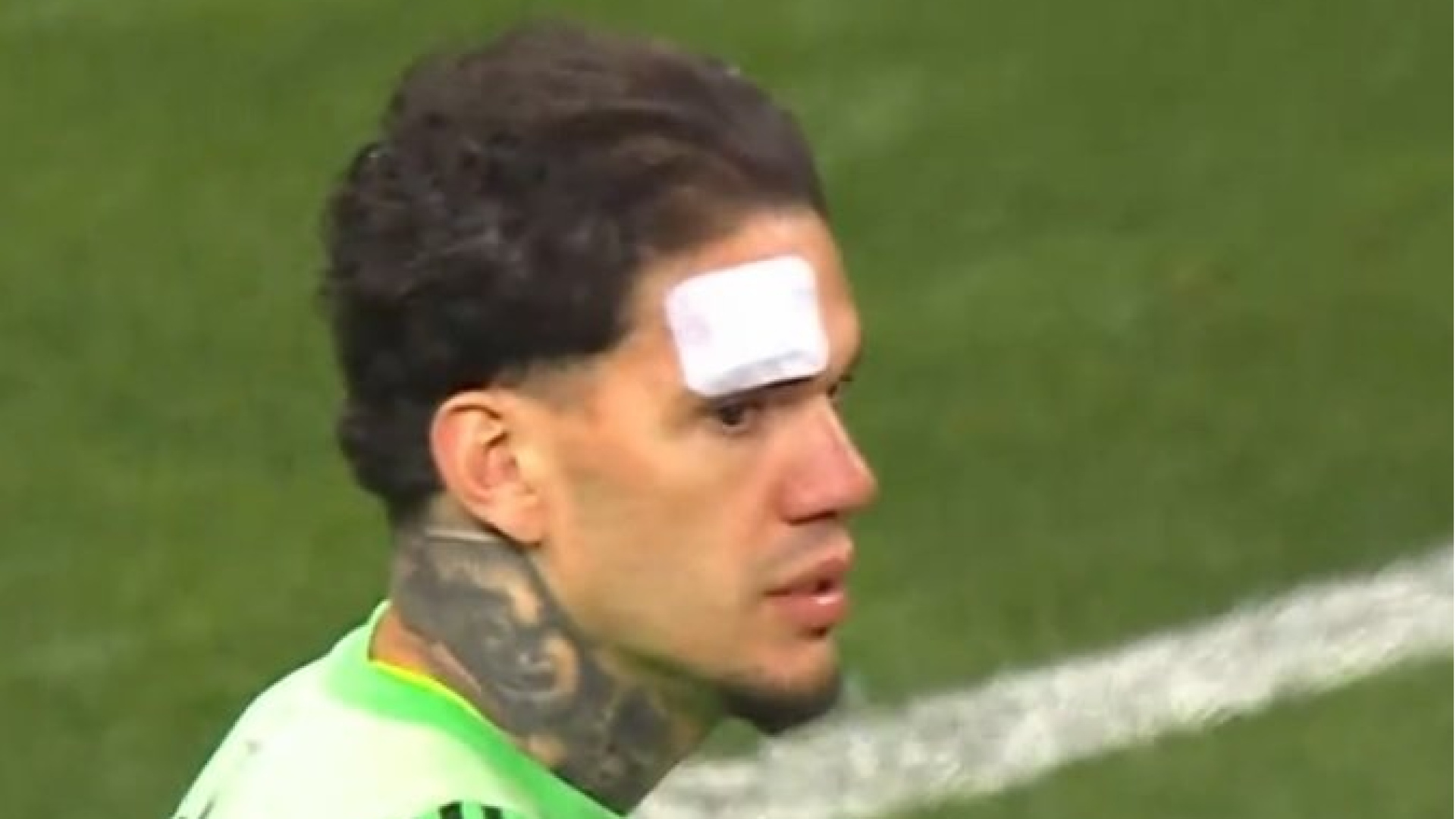 Fenerbahçe'nin Kayserispor Maçında Ederson'a Tribünden Madde Atıldı, Kaşı Açıldı