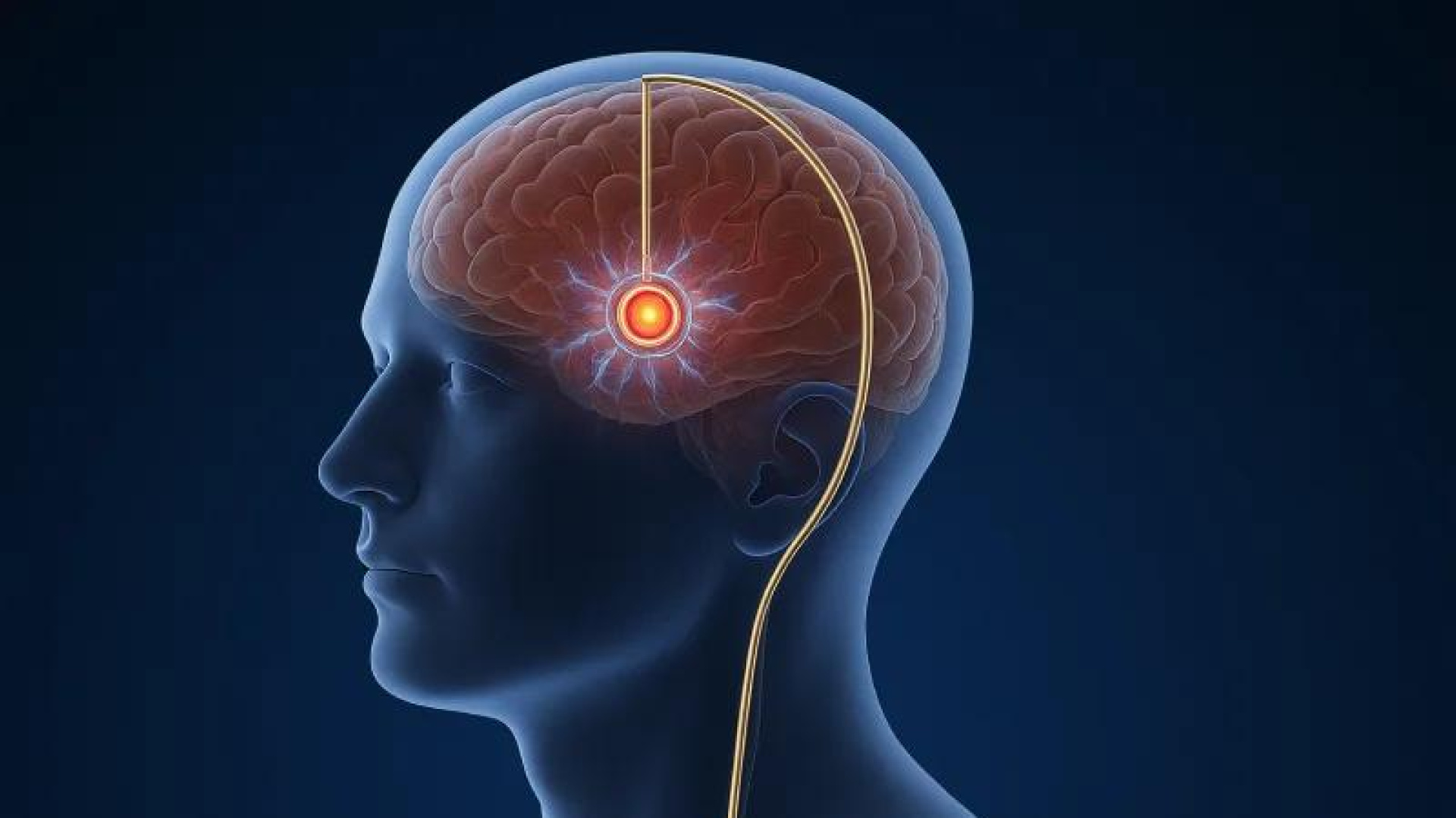 Son gelişmeler! Türkiye'de beyin pili ameliyatı olan Parkinson hastalarına dünyanın bir ucunda bile pil ayarı mümkün