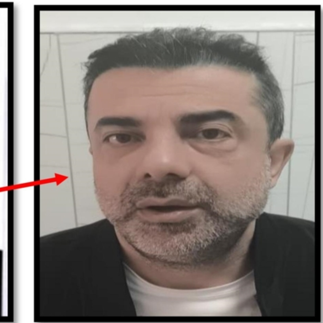 Cinayetin ardından estetik yaptırıp yüzünü değiştirdi!