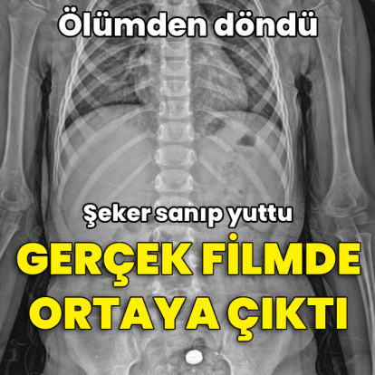 Şeker sanıp yuttu, pil olduğu filmde ortaya çıktı