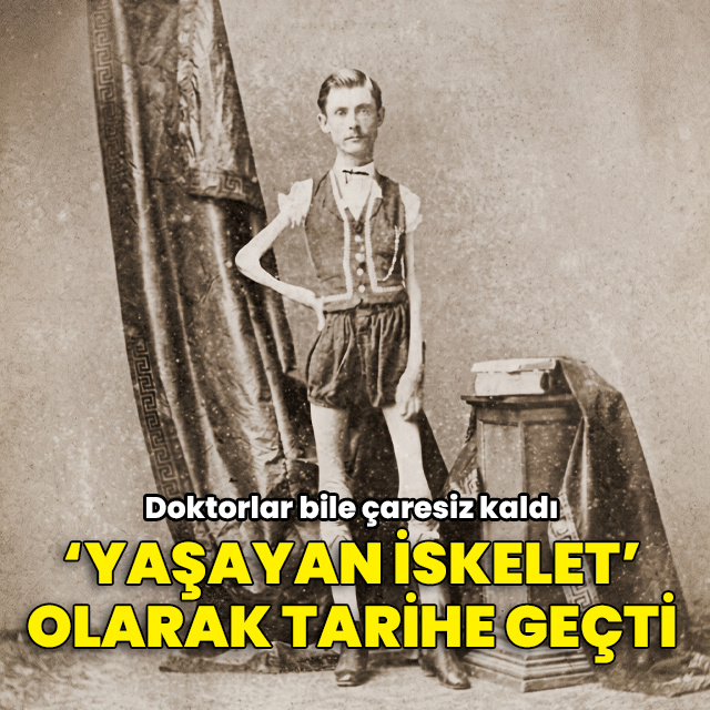 19. yüzyılın "Yaşayan İskelet"i olarak tarihe geçti