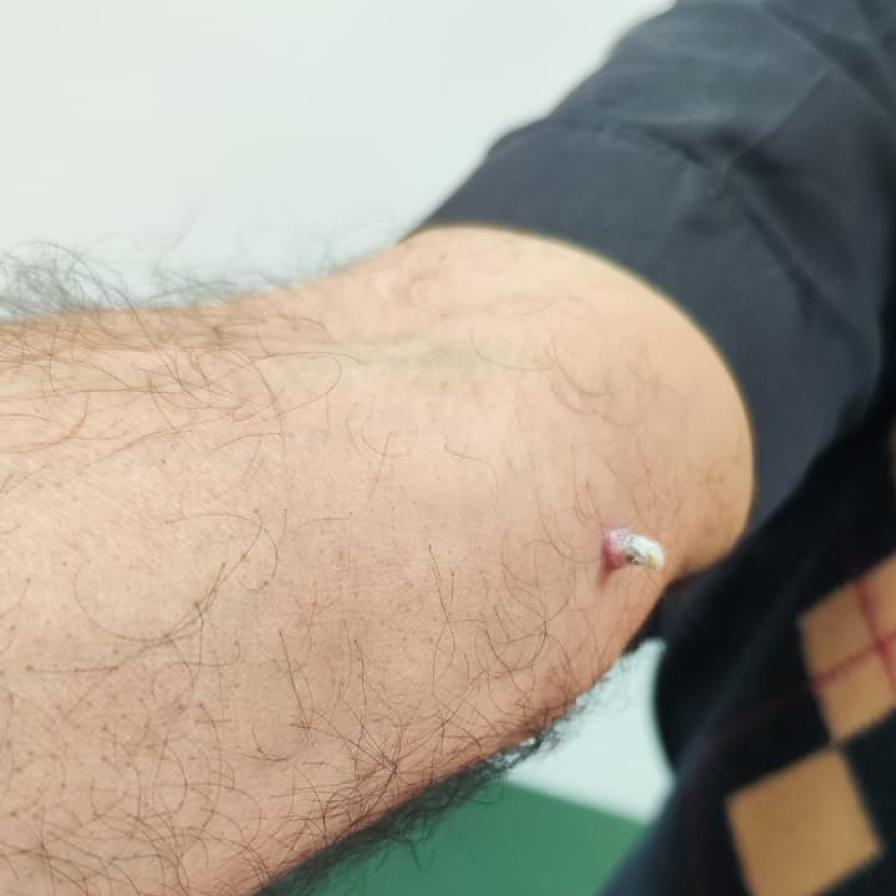Kolundaki yara için gitti, kanser olduğunu öğrendi