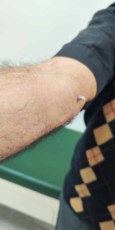 Kolundaki yara için gitti, kanser olduğunu öğrendi