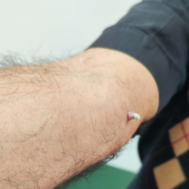 Kolundaki yara için gitti, kanser olduğunu öğrendi