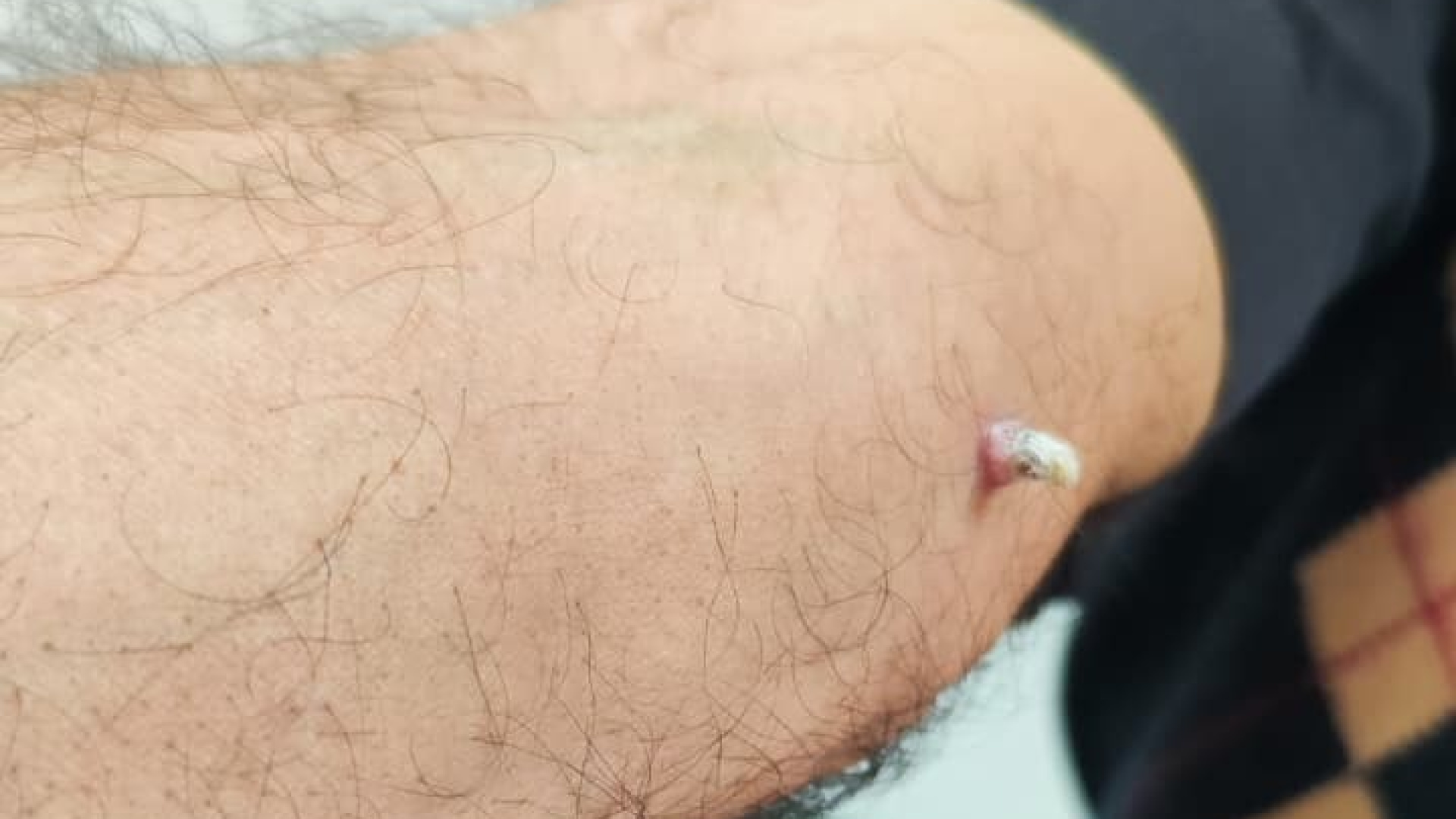 Kolundaki yara için hastaneye gitti, cilt kanseri olduğunu öğrendi