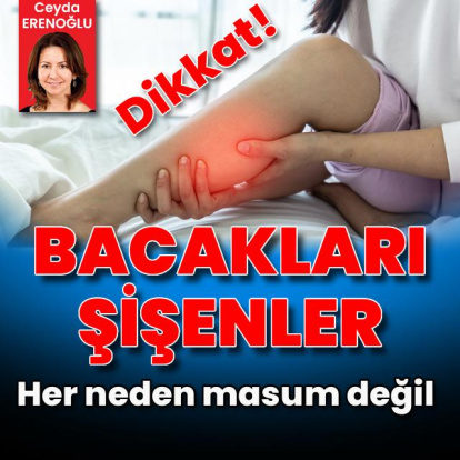 Bacakları şişenler dikkat! Her neden masum değil