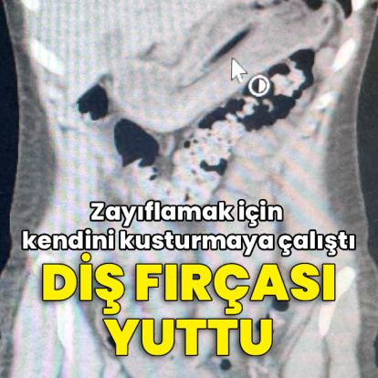 Zayıflamak için kendini kusturmaya çalışırken diş fırçası yuttu