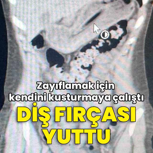 Zayıflamak için kendini kusturmaya çalışırken diş fırçası yuttu