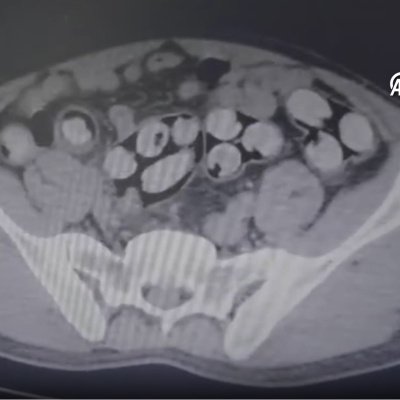 Tam 139 kapsül! Tomografide ortaya çıktı