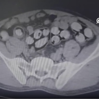 Tam 139 kapsül! Tomografide ortaya çıktı