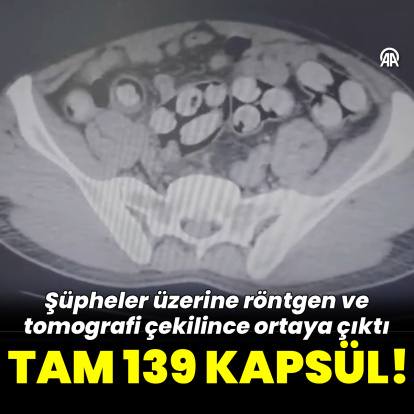 Tam 139 kapsül! Tomografide ortaya çıktı