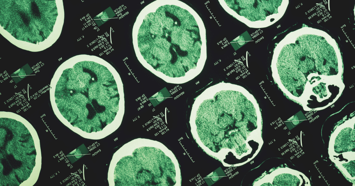 Alzheimer unutkanlıkla başlamıyor