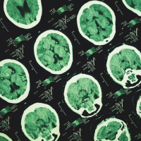 Alzheimer unutkanlıkla başlamıyor