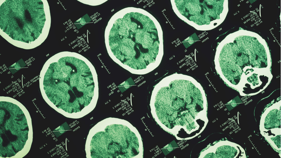 Alzheimer unutkanlıkla başlamıyor