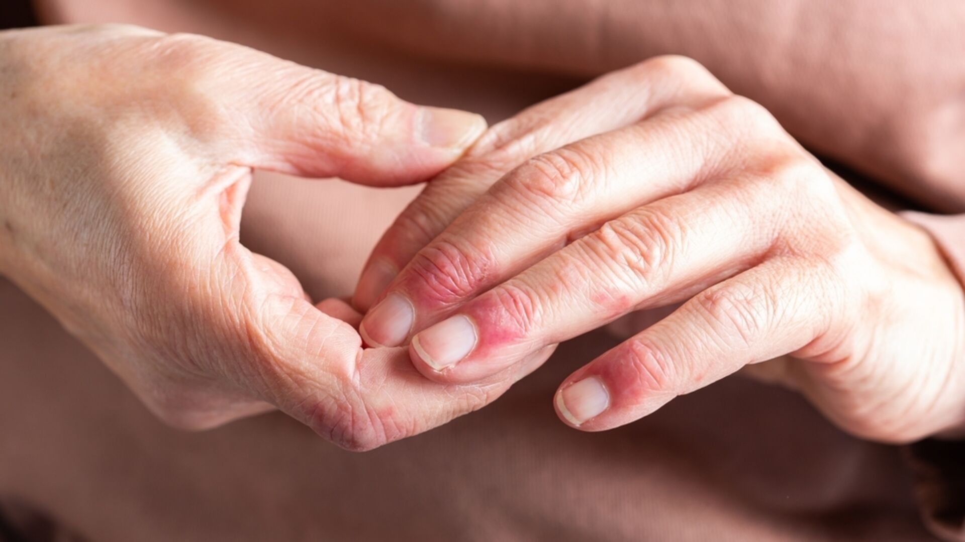 Atopik dermatitin görünmeyen yükü sanat eserleriyle görünür oldu