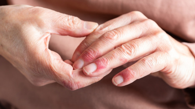 Atopik dermatitin görünmeyen yükü sanat eserleriyle görünür oldu