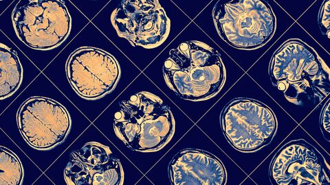 Günün notu | Alzheimer tanısında kan testi dönemi!