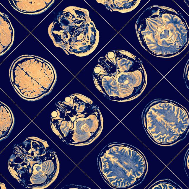 Alzheimer tanısında kan testi dönemi!