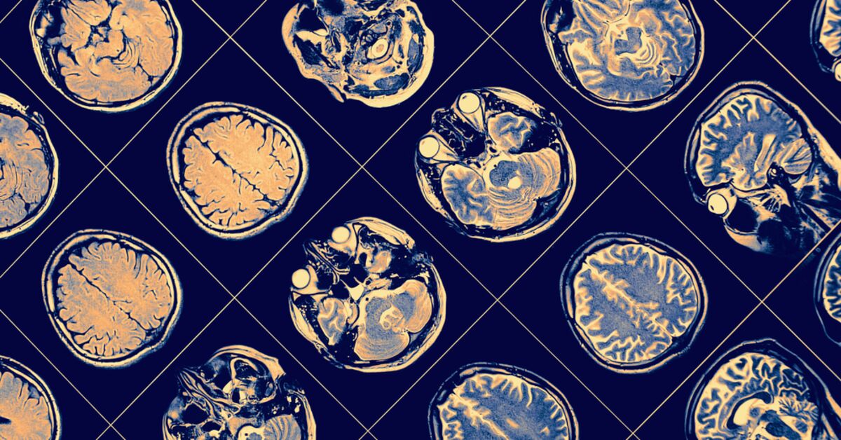 Alzheimer tanısında kan testi dönemi!
