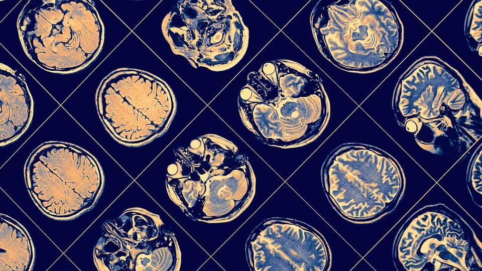 Alzheimer tanısında kan testi dönemi!