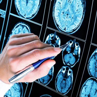 Alzheimer tedavisinde yeni dönem! Antikor tedavisi evde uygulanabilecek