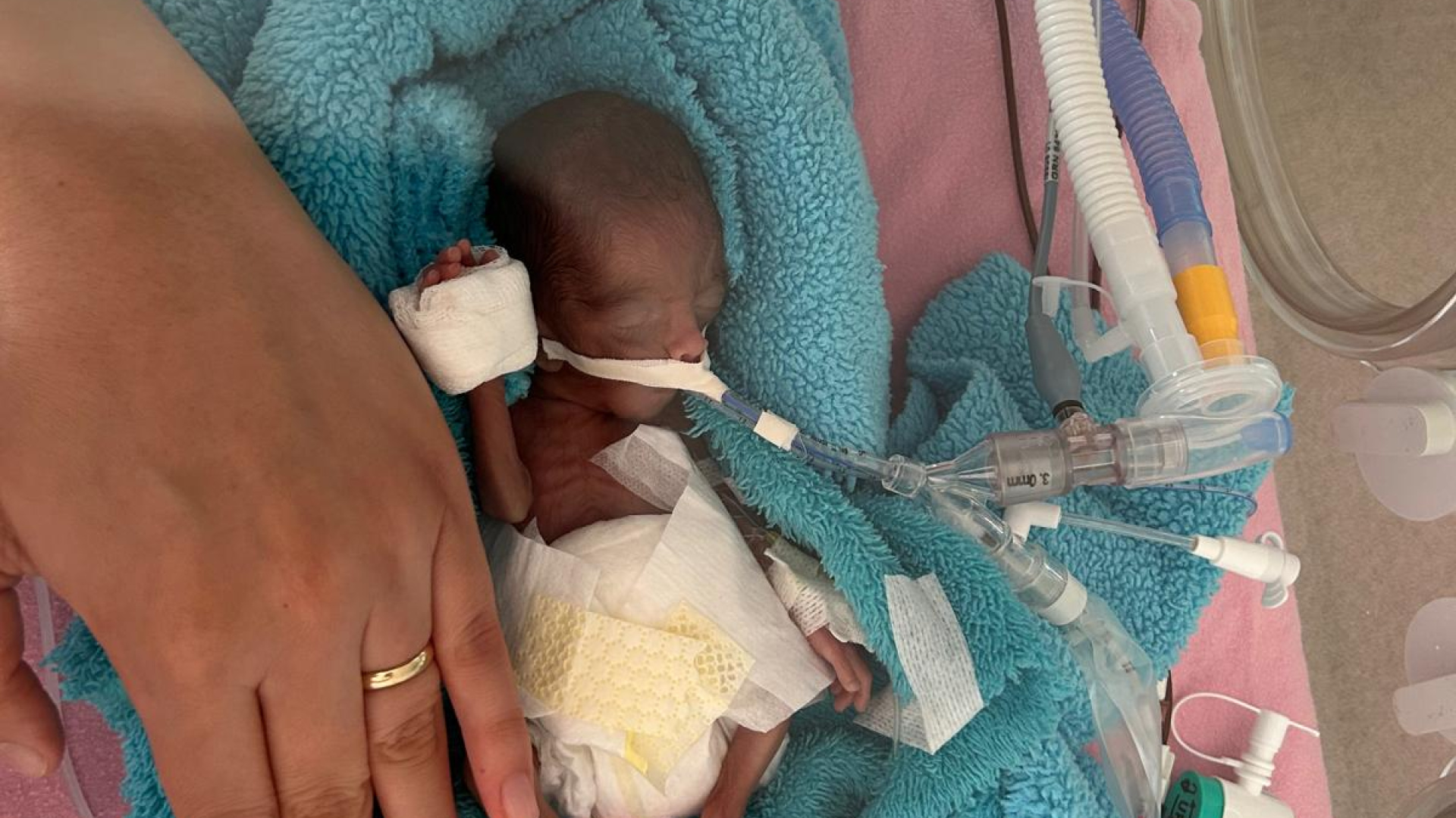 Mucizevi Dönüş: 350 Gramlık Bebek 240 Gün Sonra Hayata Tutundu