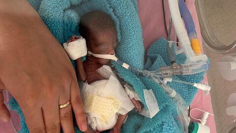 350 gram doğmuştu! Rüzgar bebek 240 gün sonra yaşam mücadelesini kazandı