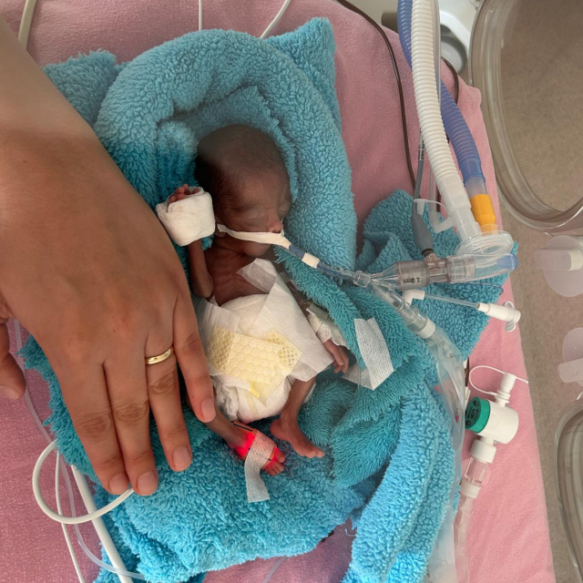 350 gram doğmuştu! Rüzgar bebek 240 gün sonra yaşam mücadelesini kazandı