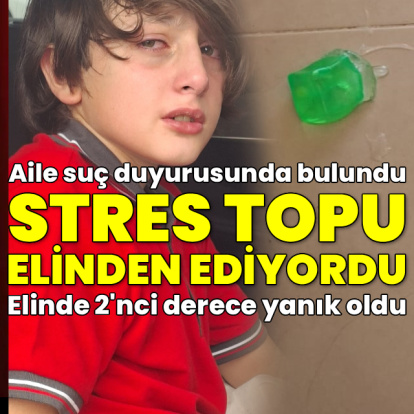 Stres oyuncağı elinde patladı! Yanık ve kızarık oldu