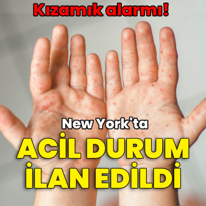 New York'ta kızamık salgını! Acil durum ilan edildi