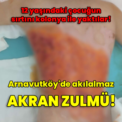 Akran zulmü! Çocuğun sırtını kolonya ile yaktılar