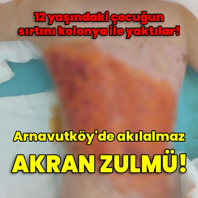 Akran zulmü! Çocuğun sırtını kolonya ile yaktılar