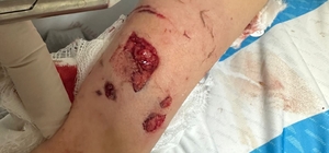 12 yaşındaki çocuk, sevdiği köpeğin saldırısında yaralandı