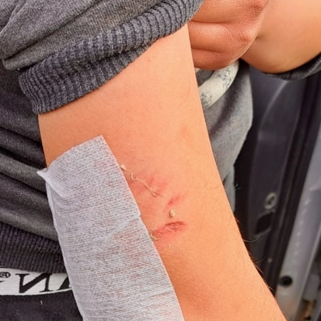 Kütahya'da sahipsiz köpeklerin saldırdığı öğrenci yaralandı