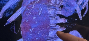 Aort damarı 11 santimetreye çıkıp patlayan hasta sağlığına kavuşturuldu