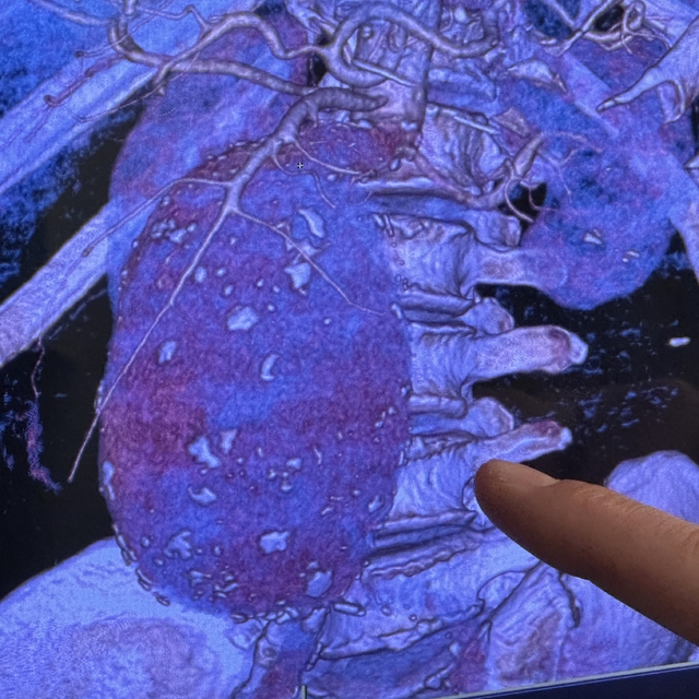 Aort damarı 11 santimetreye çıkıp patlayan hasta sağlığına kavuşturuldu