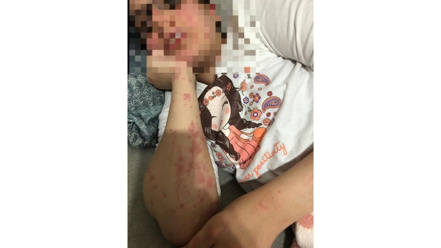Eczacının otizmli Zeynep'e verdiği muadil ilaç alerjik etki yaptı; baba şikayetçi oldu