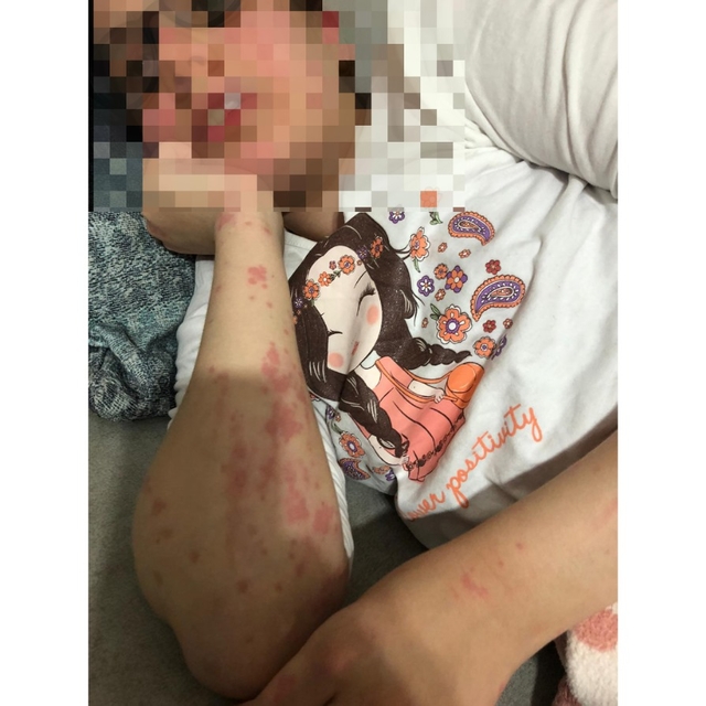 Eczacının otizmli Zeynep'e verdiği muadil ilaç alerjik etki yaptı; baba şik...