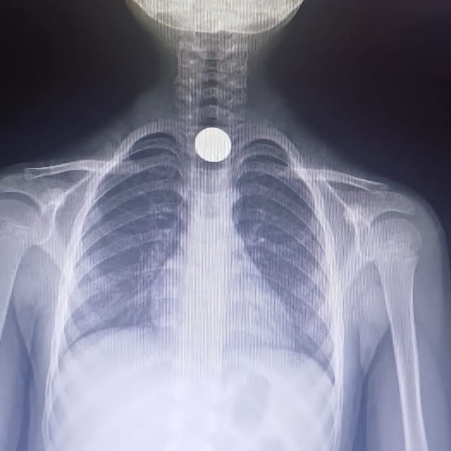 7 yaşındaki Ahmet'in yuttuğu 50 kuruş yemek borusuna takıldı